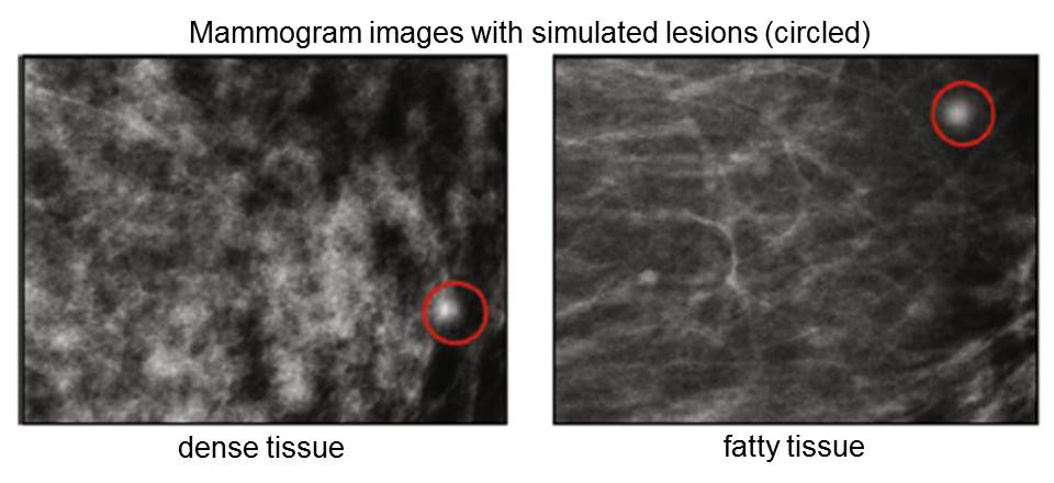 2 panel image depicting different mammogram images with simulated lesions. Left panel: dense tissue. Right panel: fatty tissue